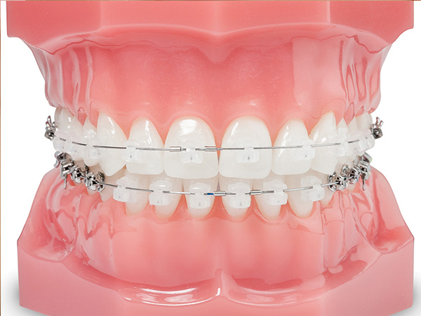 Braces Treatment Braces Dentist In Gandhinagar Niky Dental Care